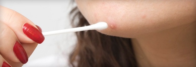 Axit salicylic cho mụn trứng cá. Sử dụng như thế nào để không gây bỏng, có tác dụng gì trong viên uống, đơn thuốc có diệp hạ châu. Chỉ định và chống chỉ định