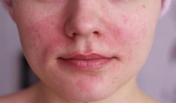Axit salicylic cho mụn trứng cá. Sử dụng như thế nào để không gây bỏng, có tác dụng gì trong viên uống, đơn thuốc có diệp hạ châu. Chỉ định và chống chỉ định