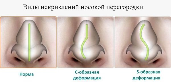 เยื่อบุโพรงจมูกเลเซอร์ส่องกล้องคลื่นวิทยุคืออะไร. ระยะหลังผ่าตัดผลที่ตามมา