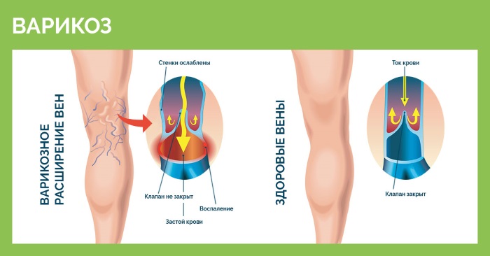 Liệu pháp xơ hóa các tĩnh mạch ở chân - quy trình này là gì, thời gian phục hồi chức năng, các biến chứng và hậu quả có thể xảy ra