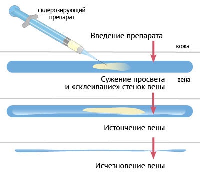 Liệu pháp xơ hóa các tĩnh mạch ở chân - quy trình này là gì, thời gian phục hồi chức năng, các biến chứng và hậu quả có thể xảy ra