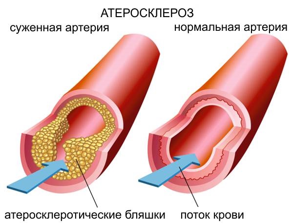 Liệu pháp xơ hóa các tĩnh mạch ở chân - quy trình này là gì, thời gian phục hồi chức năng, các biến chứng và hậu quả có thể xảy ra