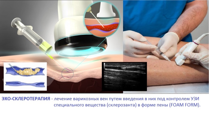 Liệu pháp xơ hóa các tĩnh mạch ở chân - quy trình này là gì, thời gian phục hồi chức năng, các biến chứng và hậu quả có thể xảy ra
