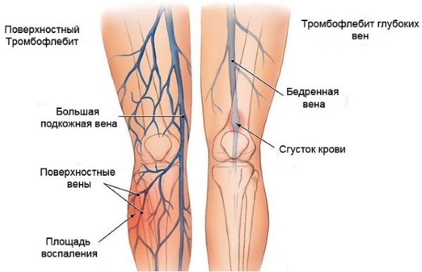 Liệu pháp xơ hóa các tĩnh mạch ở chân - quy trình này là gì, thời gian phục hồi chức năng, các biến chứng và hậu quả có thể xảy ra