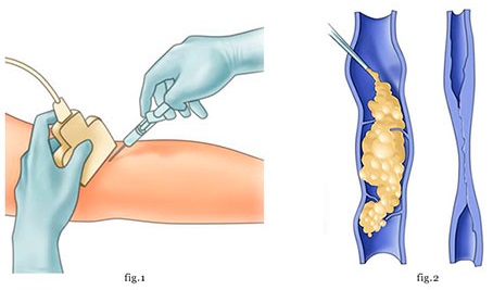 Liệu pháp xơ hóa các tĩnh mạch ở chân - quy trình này là gì, thời gian phục hồi chức năng, các biến chứng và hậu quả có thể xảy ra