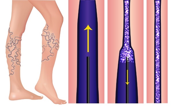 Liệu pháp xơ hóa các tĩnh mạch ở chân - quy trình này là gì, thời gian phục hồi chức năng, các biến chứng và hậu quả có thể xảy ra