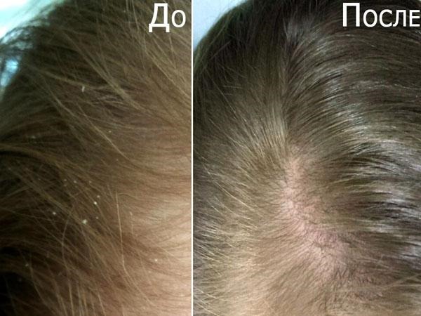 Cách trị gàu tại nhà với aspirin, soda, giấm, hành tây - dân gian. Làm thế nào để thoát khỏi một cách nhanh chóng và hiệu quả