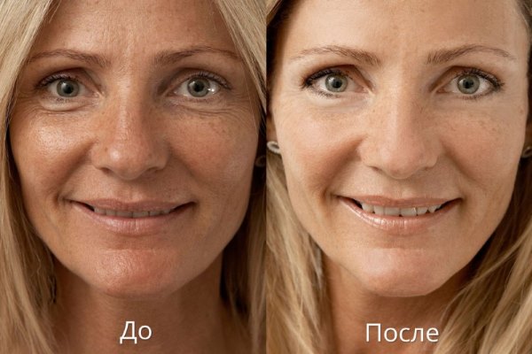 Kem dưỡng da Lora với axit hyaluronic, peptide trên khuôn mặt. Hiệu quả, đánh giá của các chuyên gia thẩm mỹ