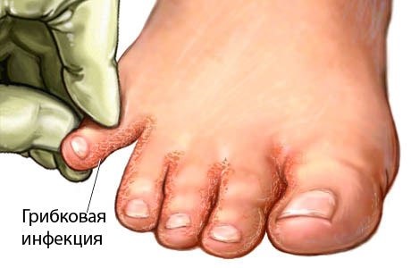 Cách khử mùi hôi chân hiệu quả. Các biện pháp khắc phục tốt nhất ở hiệu thuốc, nguyên nhân và cách điều trị chứng ra mồ hôi