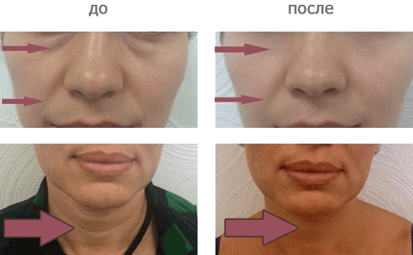 Carboxytherapy - สำหรับใบหน้าในด้านความงามคืออะไร: ไม่ฉีดไม่รุกรานการฉีด ก่อนและหลังภาพถ่ายราคาบทวิจารณ์