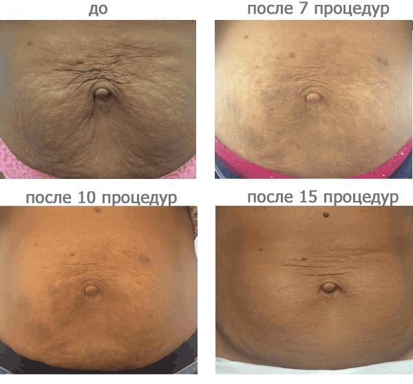 Carboxytherapy - สำหรับใบหน้าในด้านความงามคืออะไร: ไม่ฉีดไม่รุกรานการฉีด ก่อนและหลังภาพถ่ายราคาบทวิจารณ์