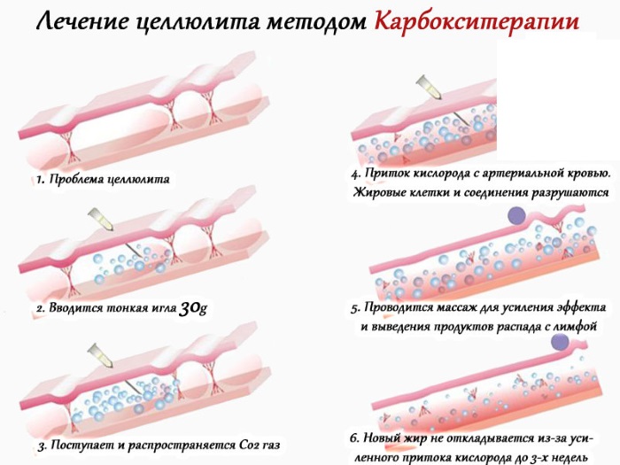 Carboxytherapy - สำหรับใบหน้าในด้านความงามคืออะไร: ไม่ฉีดไม่รุกรานการฉีด ก่อนและหลังภาพถ่ายราคาบทวิจารณ์