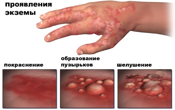 Зорка крема. Упутство за употребу људима са испуцаним петама, варикозним венама, псоријазом, петним остругама, дерматитисом, екцемом, хемороидима