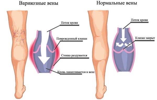 Зорка крема. Упутство за употребу људима са испуцаним петама, варикозним венама, псоријазом, петним остругама, дерматитисом, екцемом, хемороидима