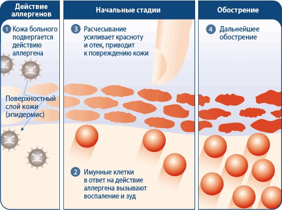 Зорка крема. Упутство за употребу људима са испуцаним петама, варикозним венама, псоријазом, петним остругама, дерматитисом, екцемом, хемороидима