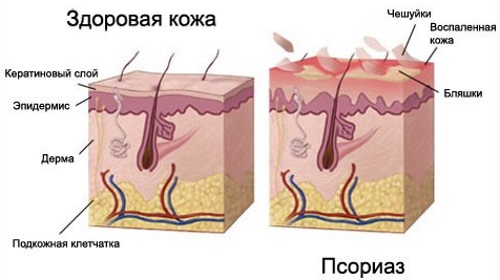 Зорка крема. Упутство за употребу људима са испуцаним петама, варикозним венама, псоријазом, петним остругама, дерматитисом, екцемом, хемороидима