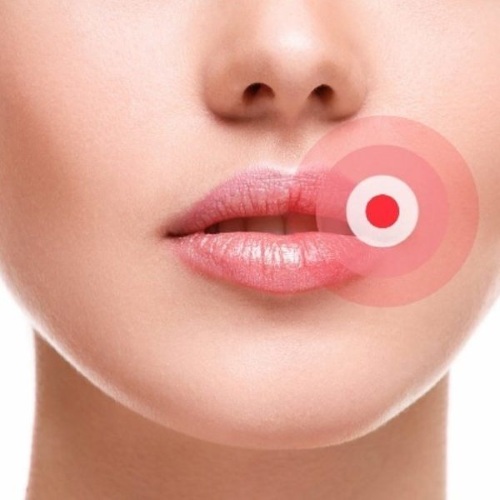 Làm lạnh mặt bằng nitơ lỏng - nó là gì, nó được thực hiện như thế nào, chỉ định và chống chỉ định, kết quả. Giá, đánh giá, ảnh