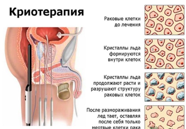 Làm lạnh mặt bằng nitơ lỏng - nó là gì, nó được thực hiện như thế nào, chỉ định và chống chỉ định, kết quả. Giá, đánh giá, ảnh