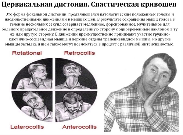 Xeomin. Hướng dẫn sử dụng trong thẩm mỹ, thần kinh. Giá cả, chất tương tự