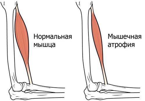 Xeomin. Hướng dẫn sử dụng trong thẩm mỹ, thần kinh. Giá cả, chất tương tự