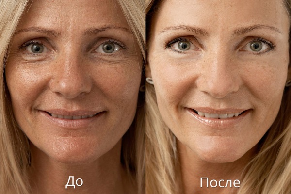 Biorevitalización láser del rostro con ácido hialurónico. Qué es, revisiones de cosmetólogos. Precio por 1 procedimiento, cuántos procedimientos deben realizarse