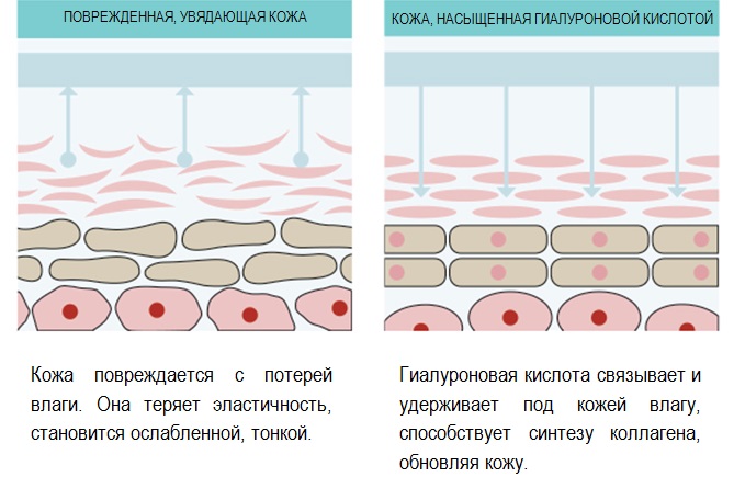 Biorevitalización láser del rostro con ácido hialurónico. Qué es, revisiones de cosmetólogos. Precio por 1 procedimiento, cuántos procedimientos deben realizarse