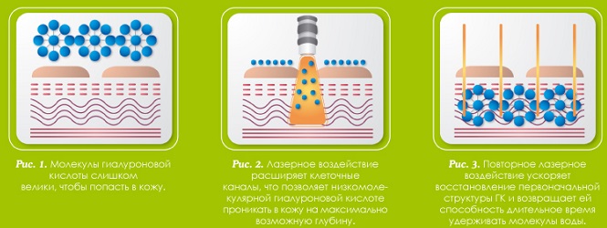 Biorevitalización láser del rostro con ácido hialurónico. Qué es, revisiones de cosmetólogos. Precio por 1 procedimiento, cuántos procedimientos deben realizarse