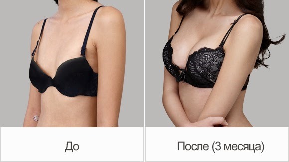 Làm đầy tuyến vú. Nhận xét của bệnh nhân, bác sĩ phẫu thuật, giá của sự gia tăng, hình ảnh trước và sau