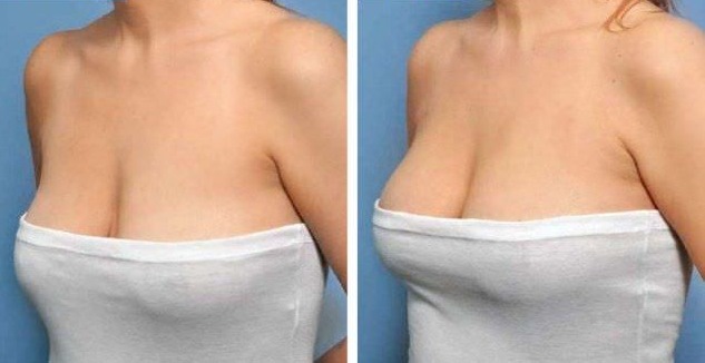 Làm đầy tuyến vú. Nhận xét của bệnh nhân, bác sĩ phẫu thuật, giá của sự gia tăng, hình ảnh trước và sau