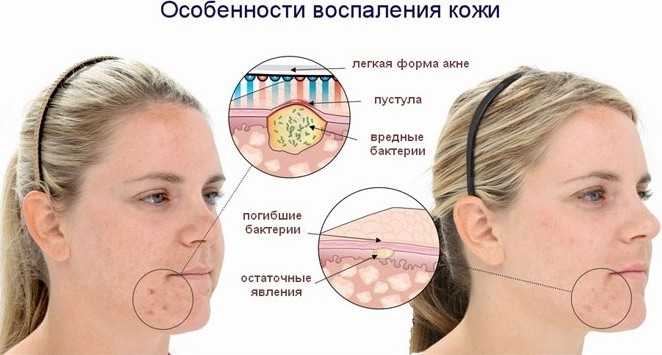 Лед за лице од бора. Предности и штете, рецепти са млеком, камилицом, алојом, першуном, кафом, уљима, лимуном