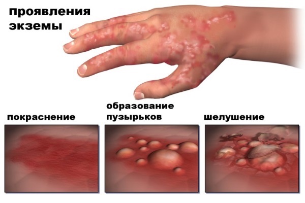 Уље целандина. Особине и примена код кожних и гљивичних болести, у козметологији, гинекологији