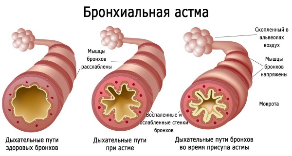 Уље целандина. Особине и примена код кожних и гљивичних болести, у козметологији, гинекологији