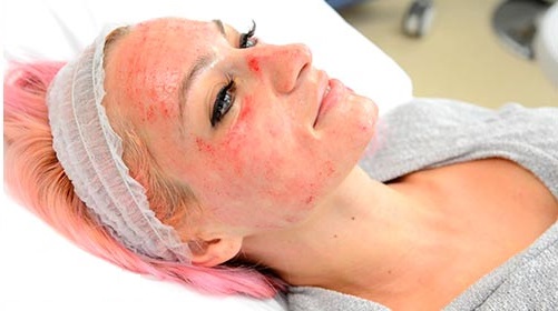 Microneedling: nó là gì, nó được thực hiện như thế nào. Thiết bị, chống chỉ định, giá của quy trình, đánh giá