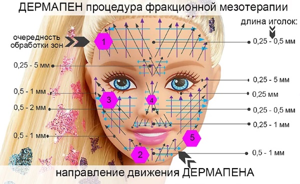 Microneedling: nó là gì, nó được thực hiện như thế nào. Thiết bị, chống chỉ định, giá của quy trình, đánh giá