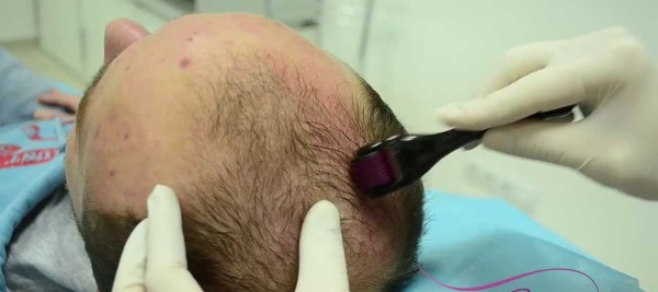 Microneedling: nó là gì, nó được thực hiện như thế nào. Thiết bị, chống chỉ định, giá của quy trình, đánh giá
