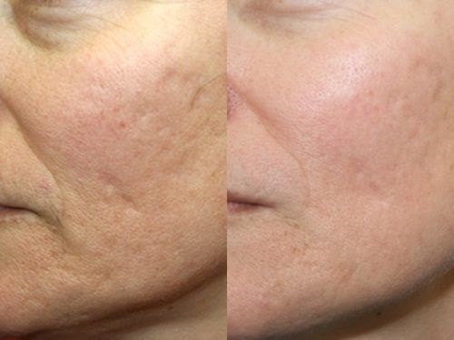 Microneedling: nó là gì, nó được thực hiện như thế nào. Thiết bị, chống chỉ định, giá của quy trình, đánh giá