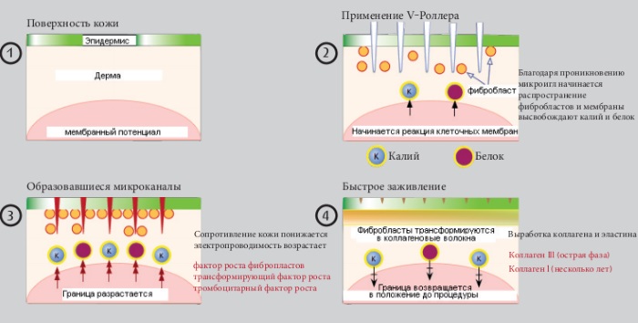 Microneedling: nó là gì, nó được thực hiện như thế nào. Thiết bị, chống chỉ định, giá của quy trình, đánh giá