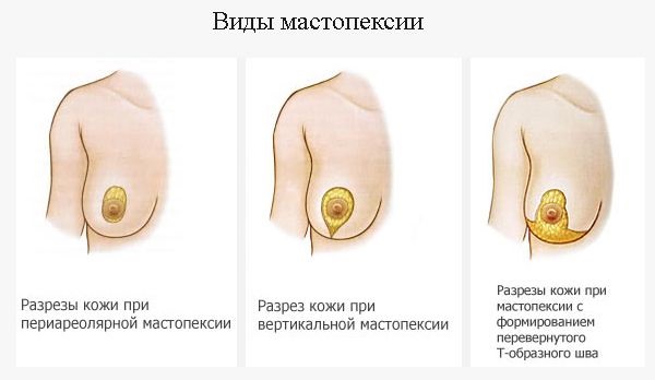 Operação de mamoplastia: redução, aumento, endoscopia laser, sem implantes, masculinização. Estágios, reabilitação e complicações