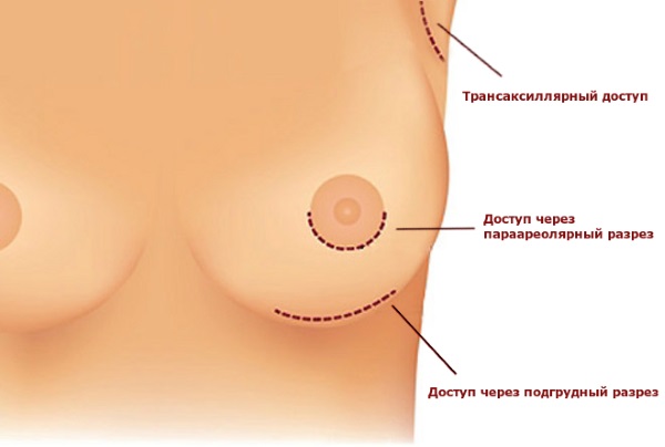 Operação de mamoplastia: redução, aumento, endoscopia laser, sem implantes, masculinização. Estágios, reabilitação e complicações