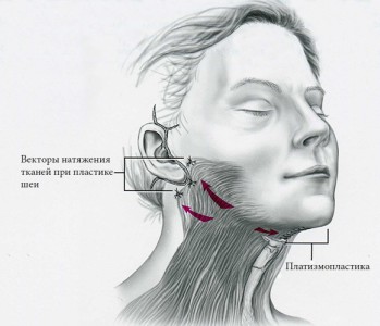 Platismoplastia - o que é, tipos: medial, Hollywood, corset, mediana, endoscópica. Avaliações e preços sobre o procedimento