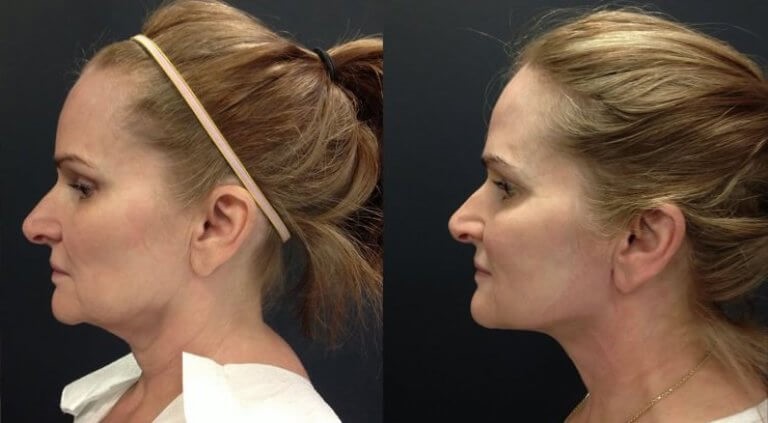 Platismoplastia - o que é, tipos: medial, Hollywood, corset, mediana, endoscópica. Avaliações e preços sobre o procedimento