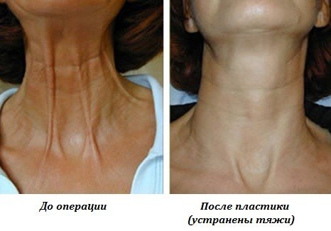 Platismoplastia - o que é, tipos: medial, Hollywood, corset, mediana, endoscópica. Avaliações e preços sobre o procedimento