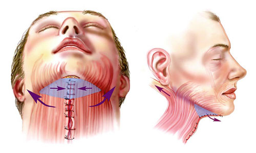 Platismoplastia - o que é, tipos: medial, Hollywood, corset, mediana, endoscópica. Avaliações e preços sobre o procedimento