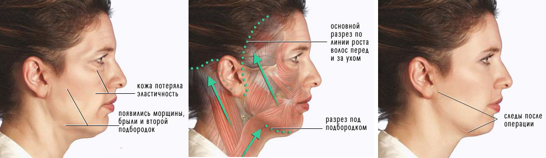 Platismoplastia - o que é, tipos: medial, Hollywood, corset, mediana, endoscópica. Avaliações e preços sobre o procedimento
