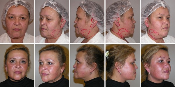 Platismoplastia - o que é, tipos: medial, Hollywood, corset, mediana, endoscópica. Avaliações e preços sobre o procedimento