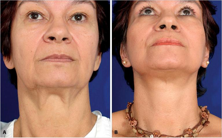 Platismoplastia - o que é, tipos: medial, Hollywood, corset, mediana, endoscópica. Avaliações e preços sobre o procedimento