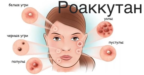 Roaccutane. Hướng dẫn sử dụng, tác dụng phụ. Cách sử dụng viên uống trị mụn, chất tương tự, giá cả