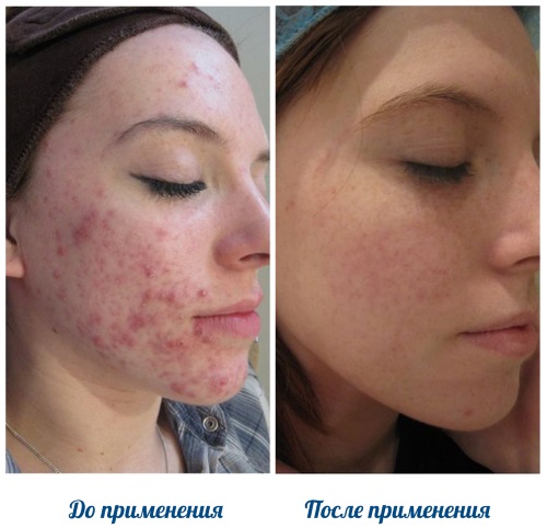 Roaccutane. Hướng dẫn sử dụng, tác dụng phụ. Cách sử dụng viên uống trị mụn, chất tương tự, giá cả
