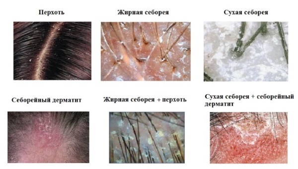 Сулцена паста. Упутство за употребу за раст косе, перут, губитак косе, подмазивање