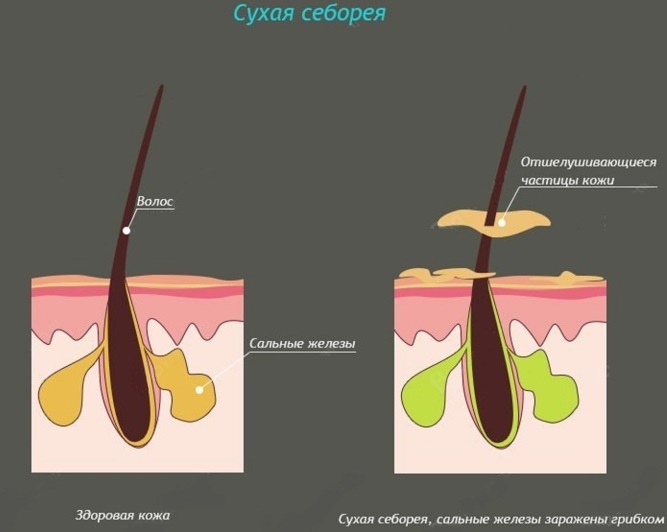 Сулцена паста. Упутство за употребу за раст косе, перут, губитак косе, подмазивање